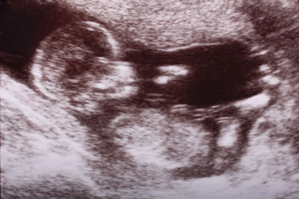 Turtle Sign Ultrasound